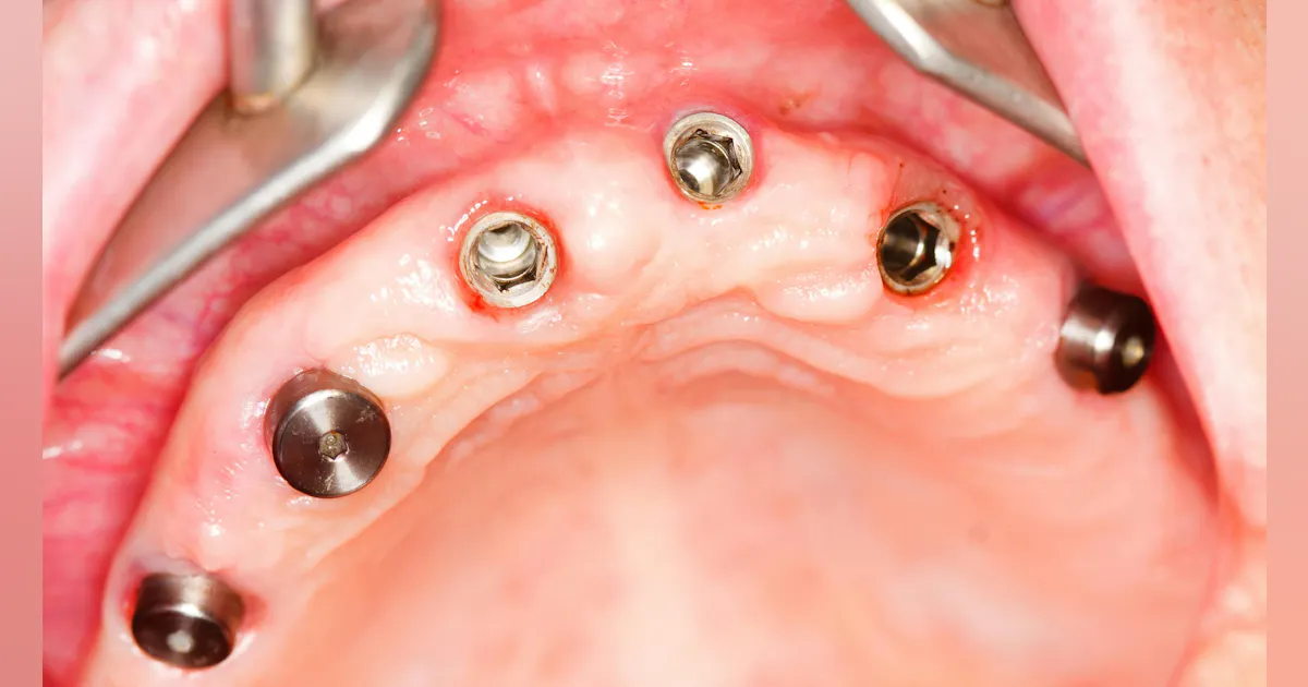 Dentists are pulling healthy teeth, pushing implants for profit, report finds Dentists are pulling healthy teeth, pushing implants for profit, report finds