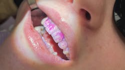 disclosing solution for dental patient education disclosing solution for dental patient education