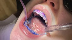 disclosing solution for dental patient education disclosing solution for dental patient education