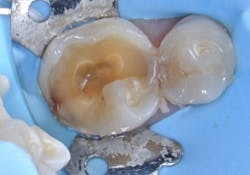 Restoration using Activa BioActive Bulk Flow. Top, pre-op, and below, pre-op x-ray. Images courtesy of Dr. Raymond Zhu. Restoration using Activa BioActive Bulk Flow. Top, pre-op, and below, pre-op x-ray. Images courtesy of Dr. Raymond Zhu.