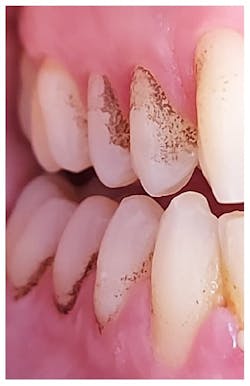 black tartar on teeth black tartar on teeth