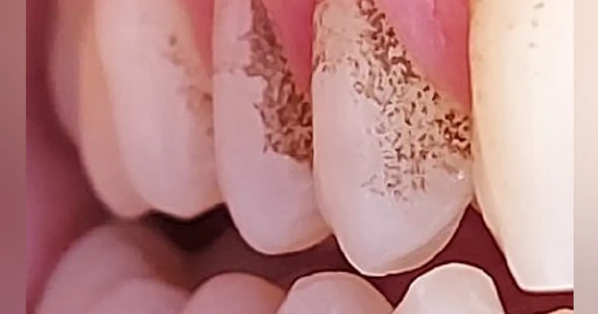 Managing black tartar and tooth stains: A challenge for dental professionals Managing black tartar and tooth stains: A challenge for dental professionals