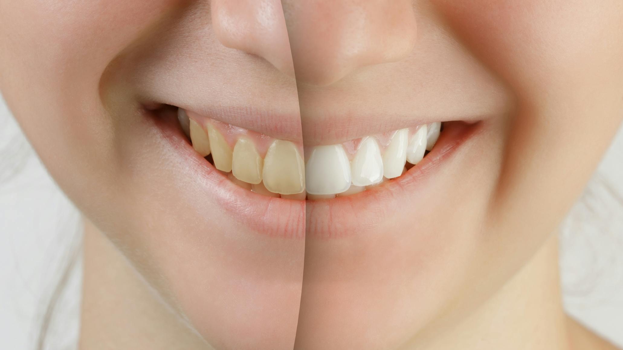 6765a2200f689735cbf74096 Teeth Whitening