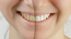 teeth_whitening