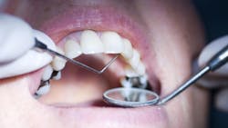amalgam fillings amalgam fillings