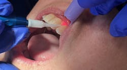 dental lasers dental lasers