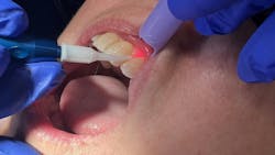 dental lasers dental lasers