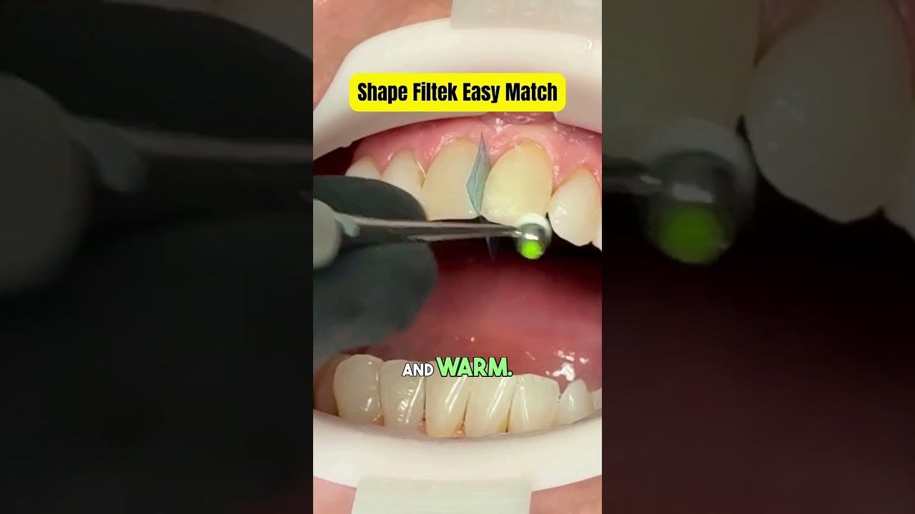 How to use Filtek Easy match for quick shade matching on anterior composites