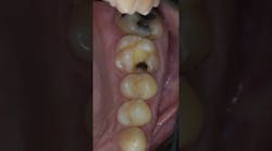 What all simple and conservative tooth preps start with What all simple and conservative tooth preps start with