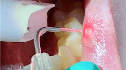 lasers in dentistry lasers in dentistry