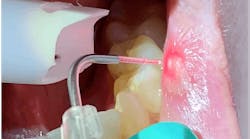 lasers in dentistry lasers in dentistry