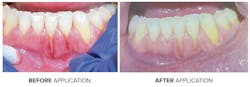 Before and after application of ClearDefense™ Before and after application of ClearDefense™