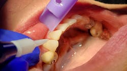 a dental laser being used on a patient a dental laser being used on a patient