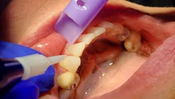 a dental laser being used on a patient a dental laser being used on a patient