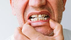 Dental patient with poor oral health Dental patient with poor oral health