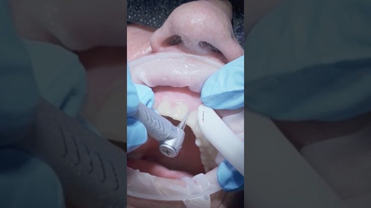 Shrinking lost time with the right dental bur