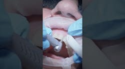 Shrinking lost time with the right dental bur Shrinking lost time with the right dental bur