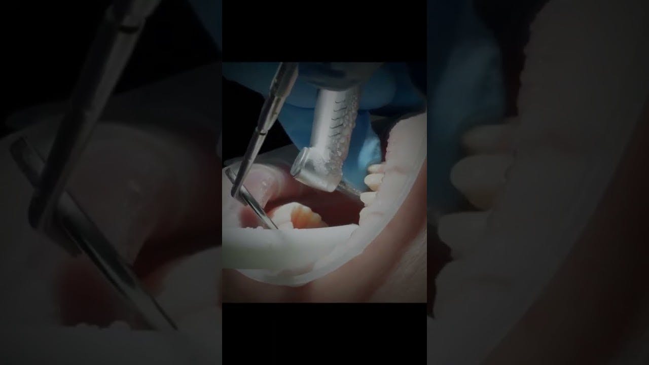 Removing all-ceramic crowns is the worst, unless