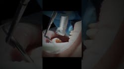 Removing all-ceramic crowns is the worst, unless Removing all-ceramic crowns is the worst, unless