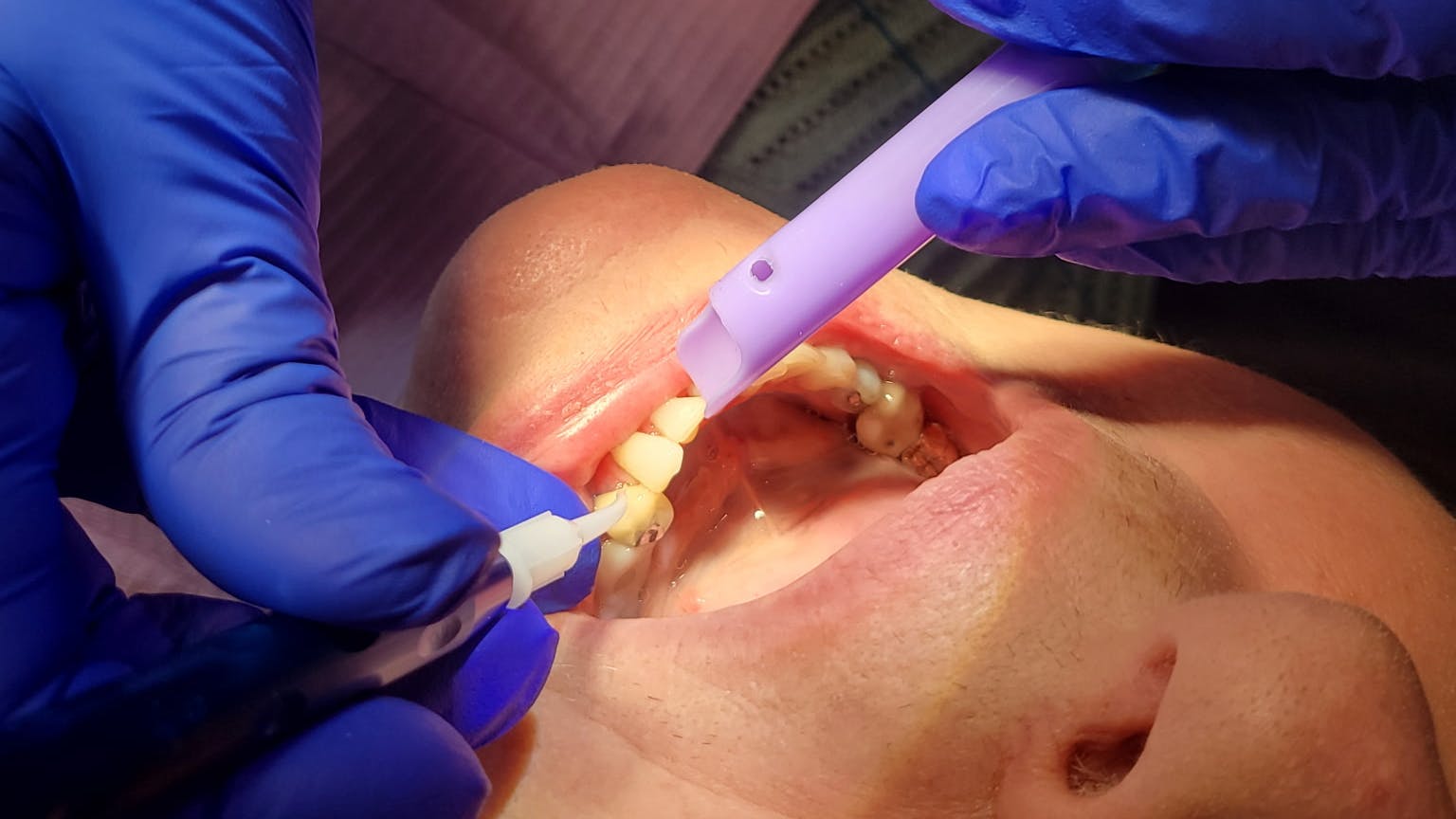 dental laser procedure