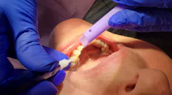 dental laser procedure
