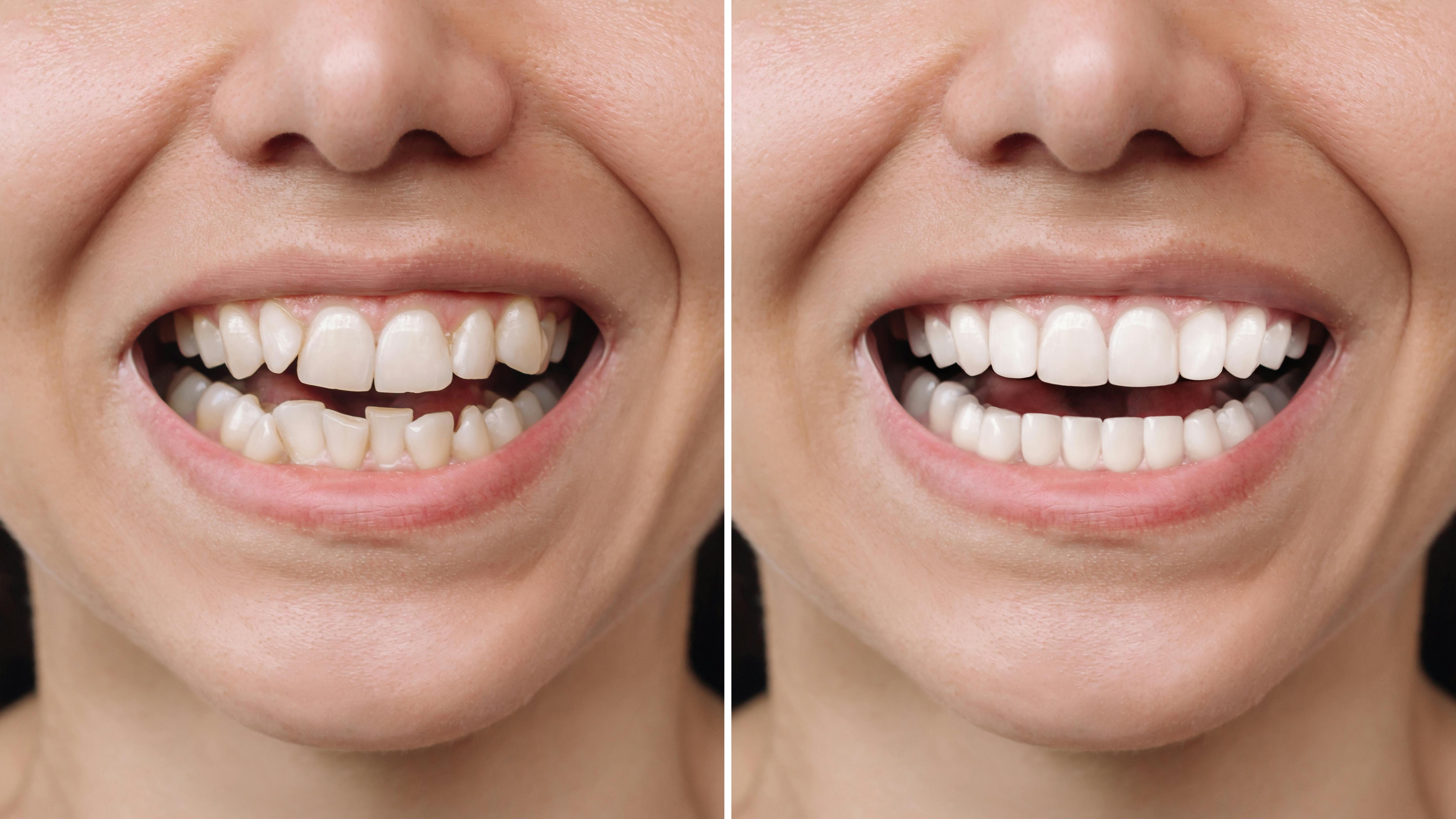 Woman before and after veneers