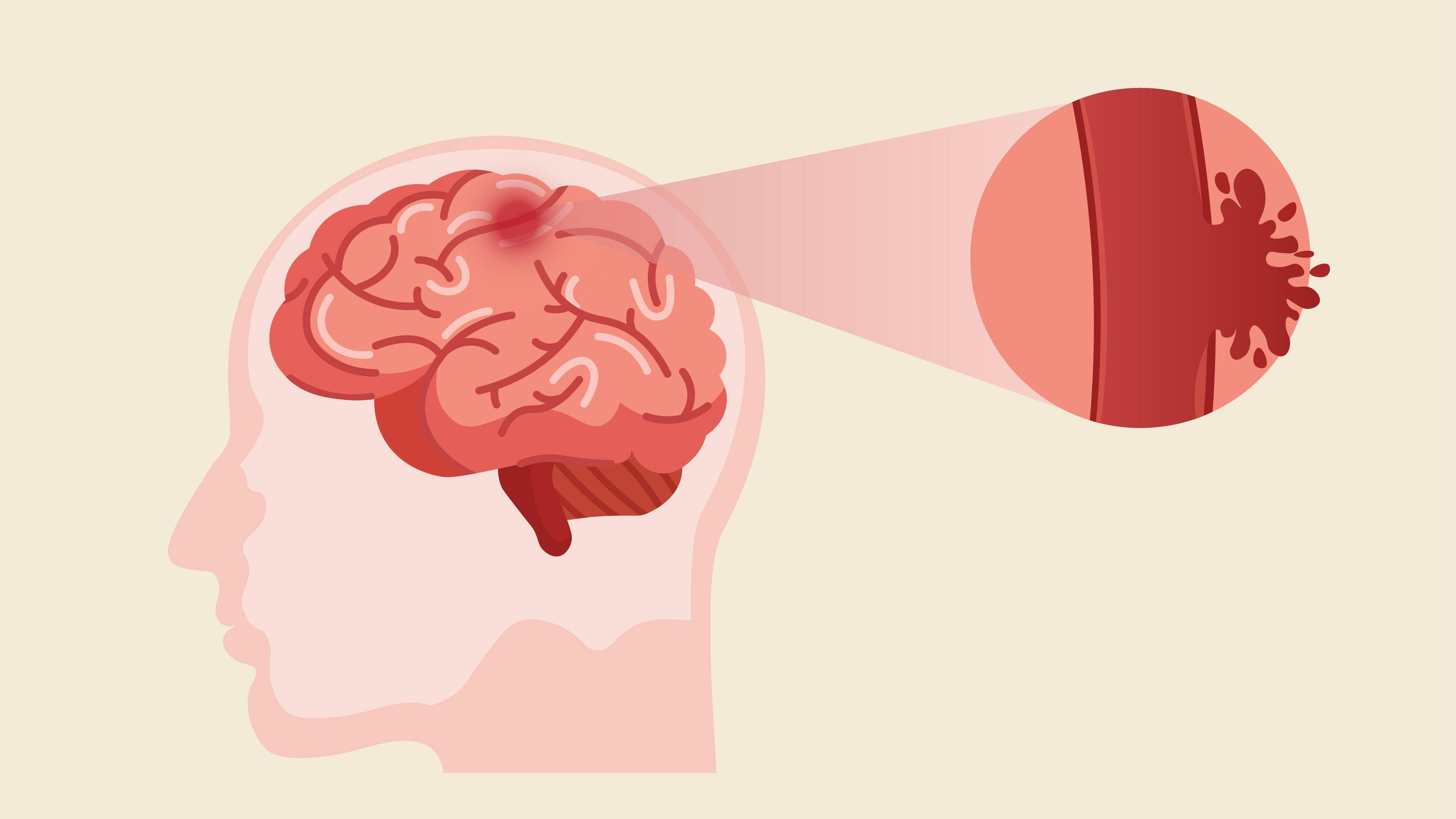 illustration of a brain aneurysm