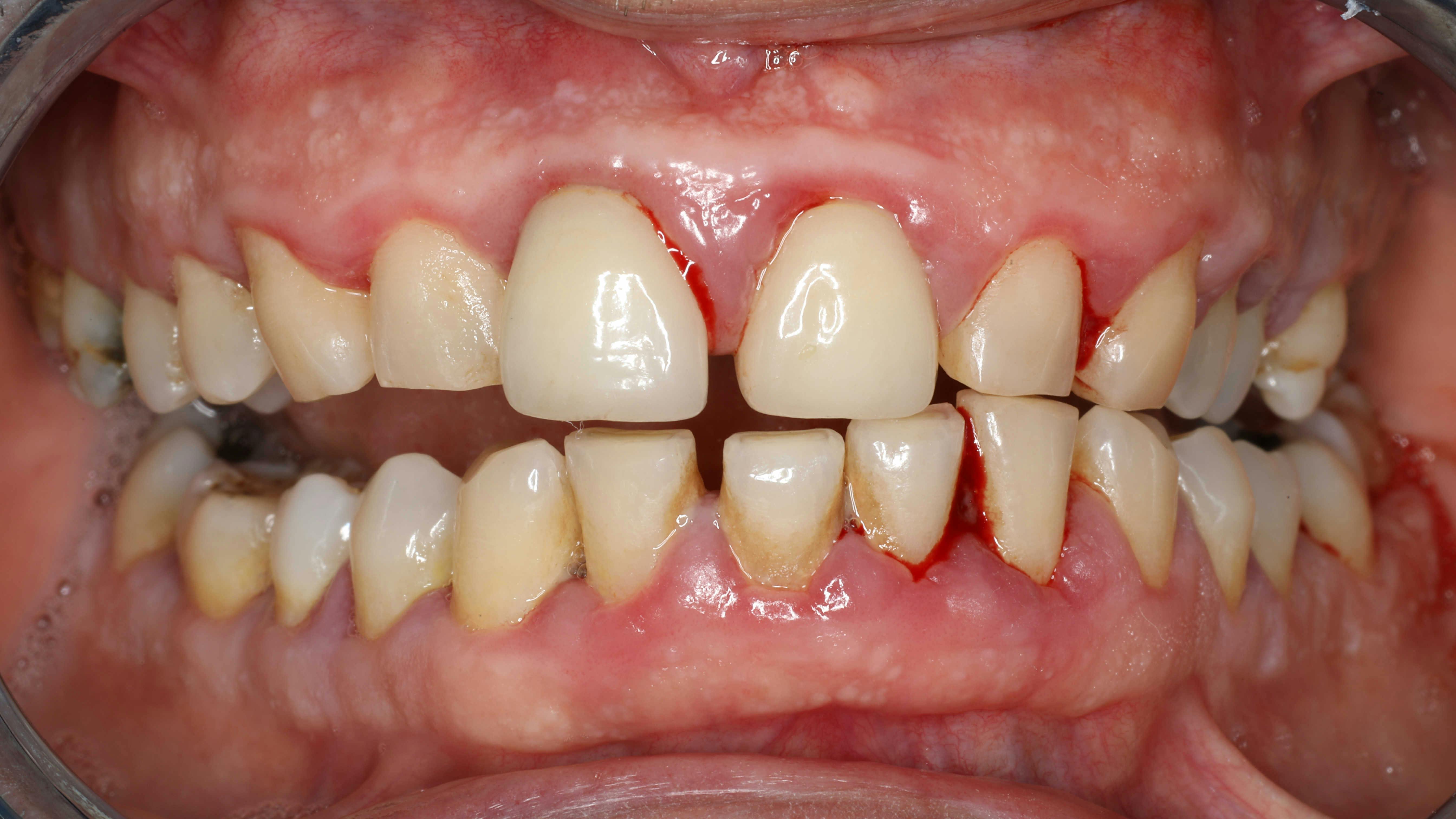 person with inflamed gums