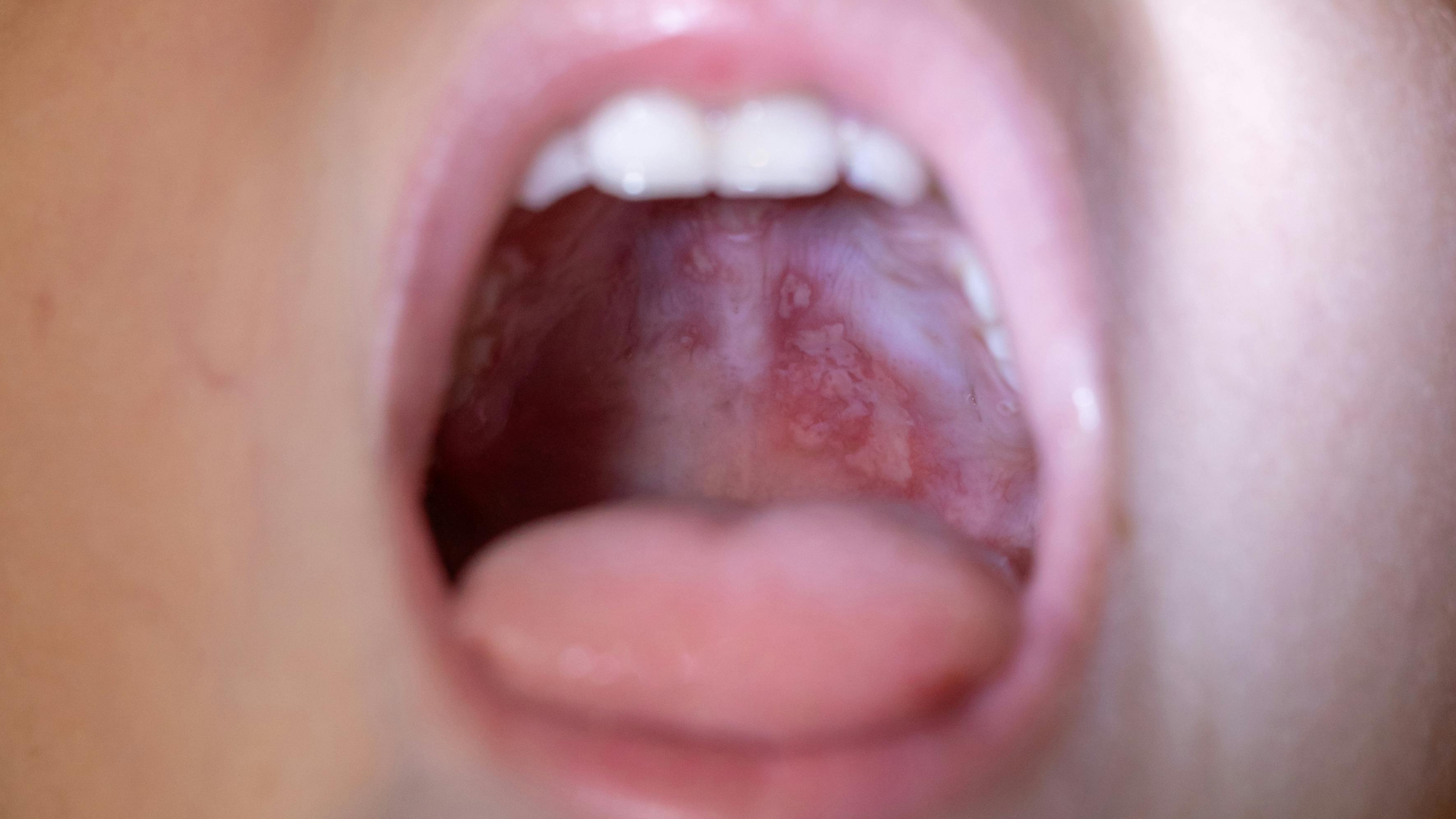 oral lesions of hand, foot and mouth disease