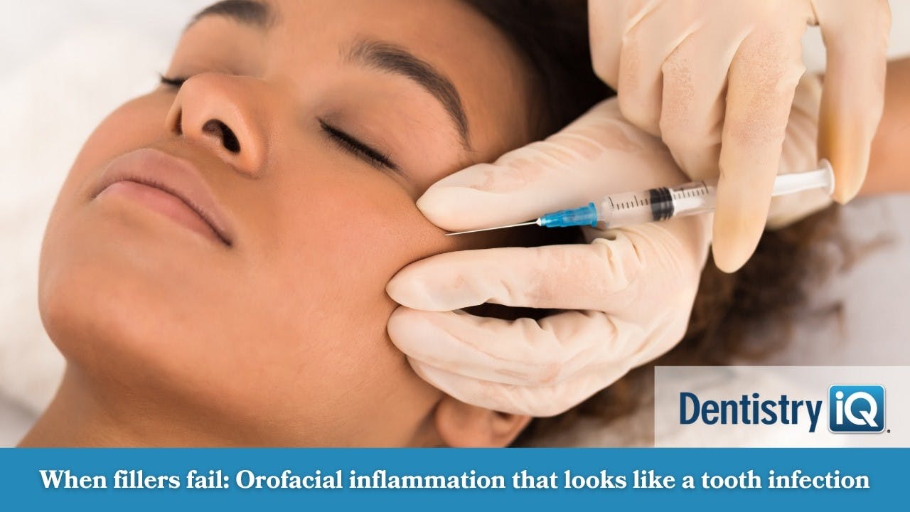 When fillers fail: Orofacial inflammation that looks like a tooth infection