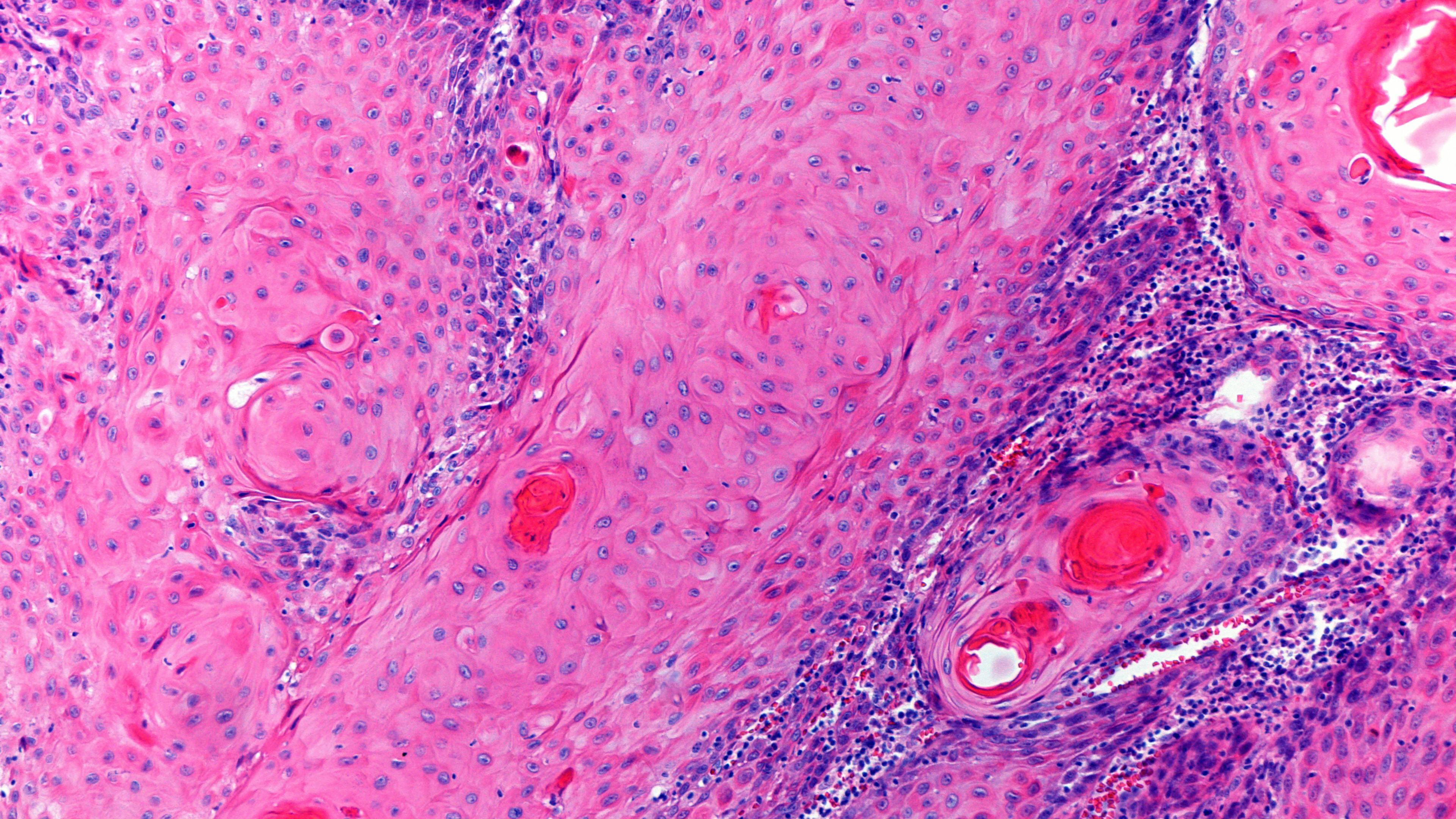 Squamous cell carcinoma (SCC)