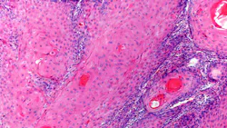 Squamous cell carcinoma (SCC)
