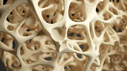 closeup of bone demonstrating osteoporosis